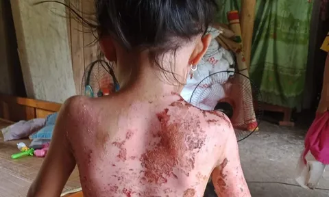 Mâu thuẫn với người mẹ, hàng xóm hắt ấm nước sôi vào bé gái 7 tuổi