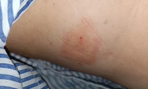 Người phụ nữ trụy tim mạch sau khi bị kiến đốt